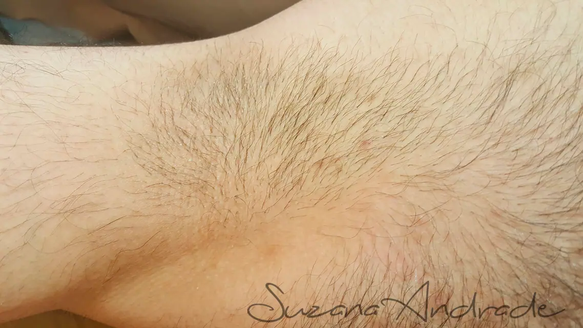 Axila com pelos antes da depilação feminina